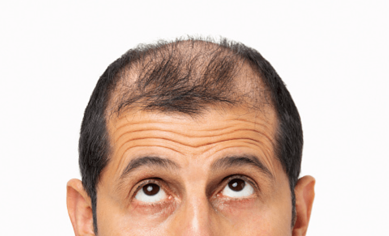 male hair loss