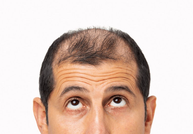 male hair loss